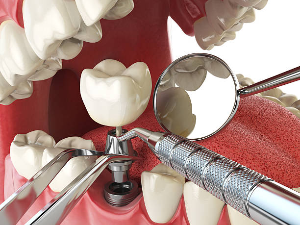 Best Emergency Broken Tooth Repair in Beach, ND